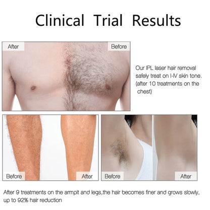 Portable IPL Laser Epilator 999999 Flashes - Painless, Permanent Hair Removal for Women’s Body and Bikini Line