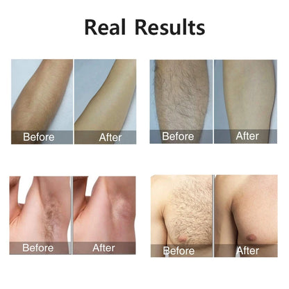 Portable IPL Laser Epilator 999999 Flashes - Painless, Permanent Hair Removal for Women’s Body and Bikini Line