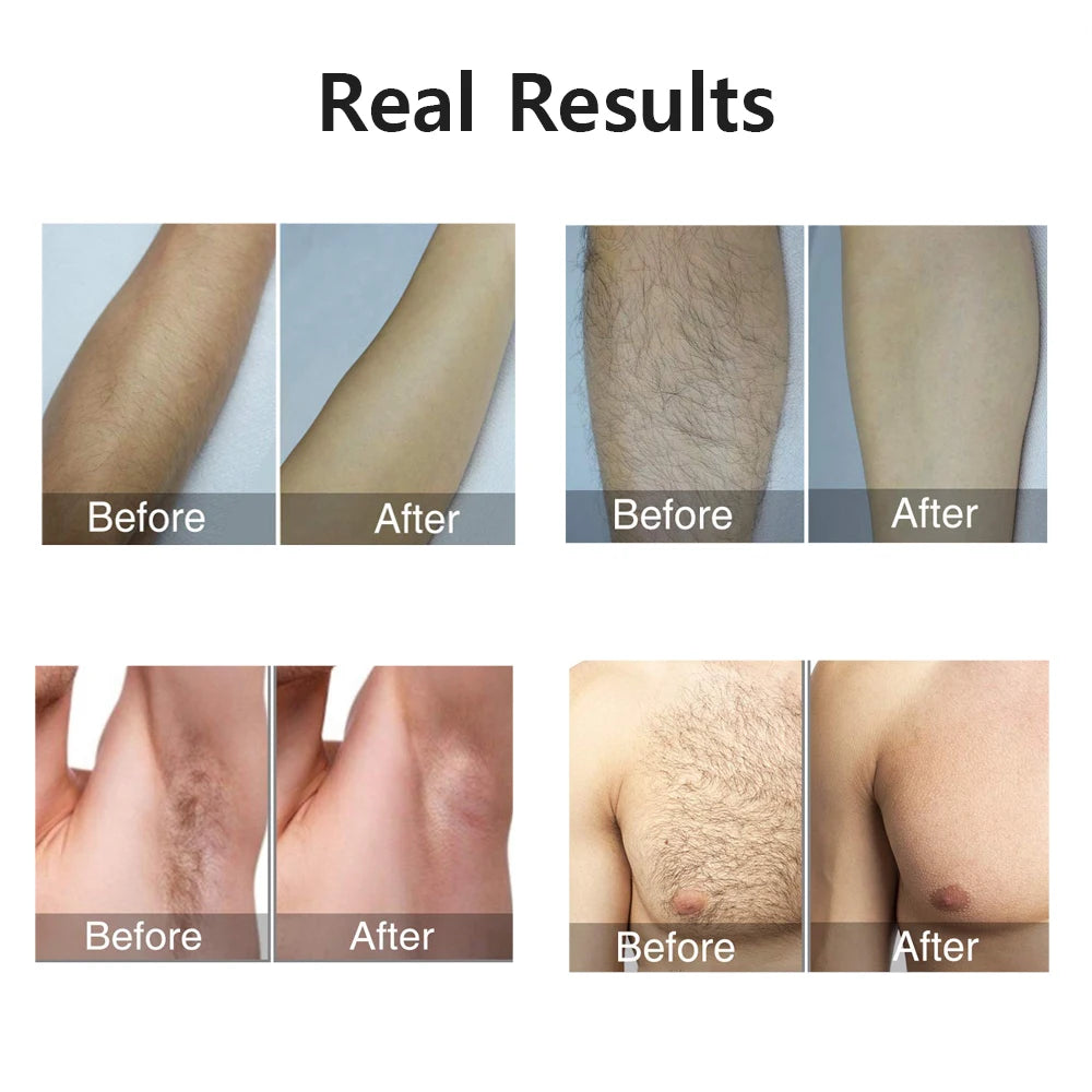 Portable IPL Laser Epilator 999999 Flashes - Painless, Permanent Hair Removal for Women’s Body and Bikini Line